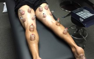 Therapeutic Cupping therapy