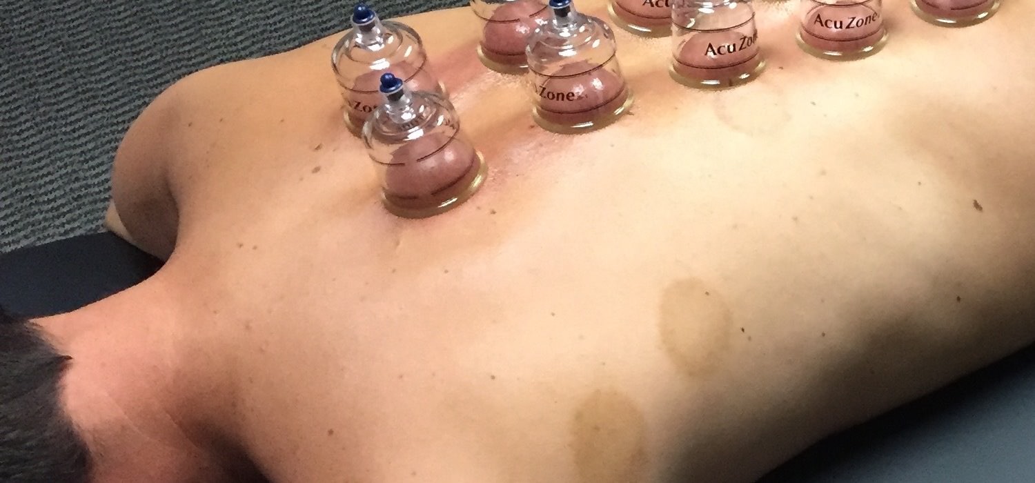 Therapeutic Cupping therapy